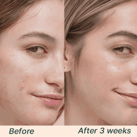 Before and after comparison of a woman's face with visible skin improvement over 3 weeks.