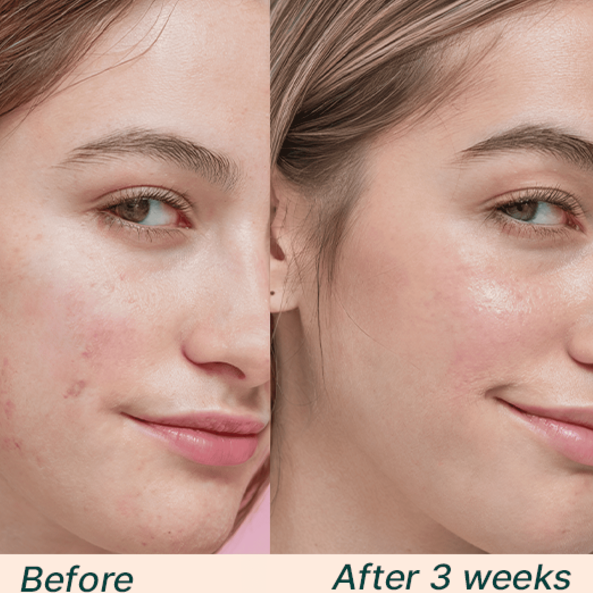 Hyaluronic Acid Quad Bundle