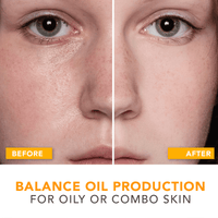 before and after comparison balance oil production for oily or combo skin