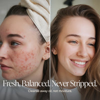 Before-and-after split screen of a woman's face showing acne improvement. The left side shows red blemishes and acne on her cheek with a beige towel wrapped around her hair.