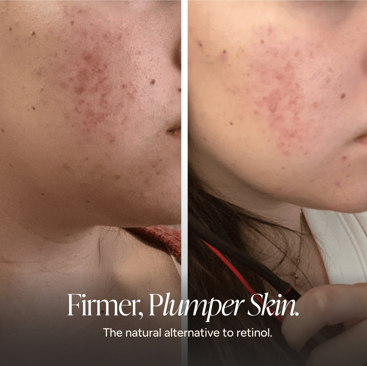 Before-and-after split screen comparison of a woman's cheek showing acne reduction and skin improvement, with the text 'Firmer, Plumper Skin. The natural alternative to retinol.
