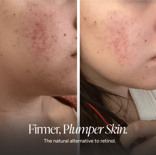 Before-and-after split screen comparison of a woman's cheek showing acne reduction and skin improvement, with the text 'Firmer, Plumper Skin. The natural alternative to retinol.