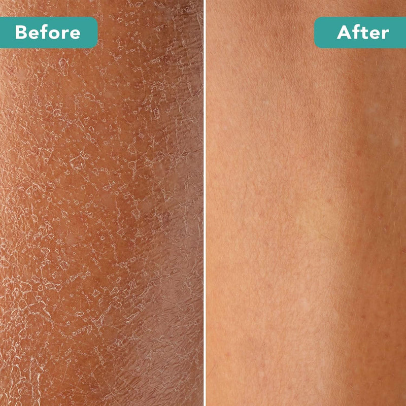 Dry Brush With Cellulite Massager - Before and After