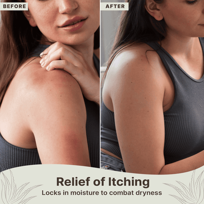 Before and after comparison of a woman's shoulder with relief of itching text.