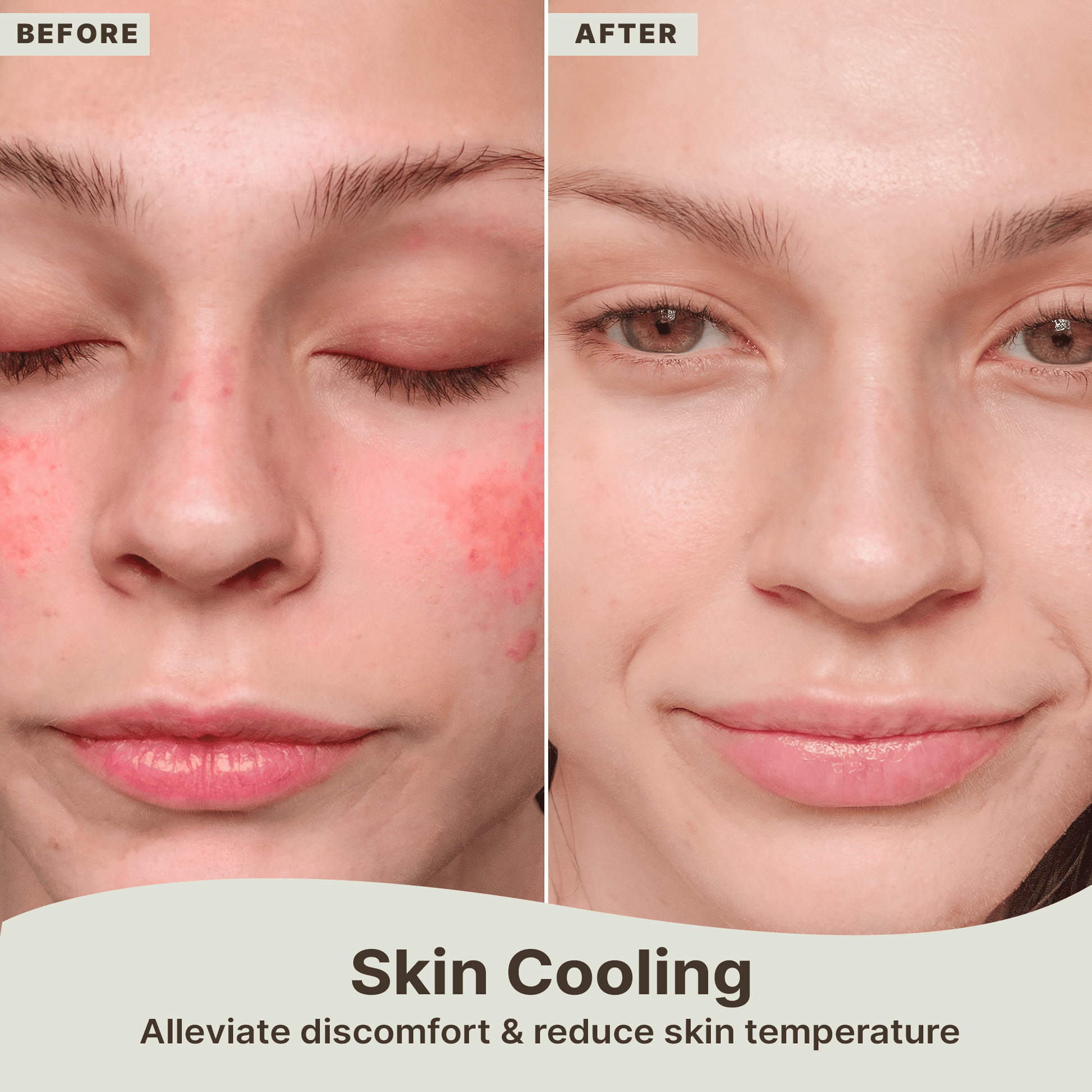 Before and after comparison of a person's face with redness, showing the effect of skin cooling.