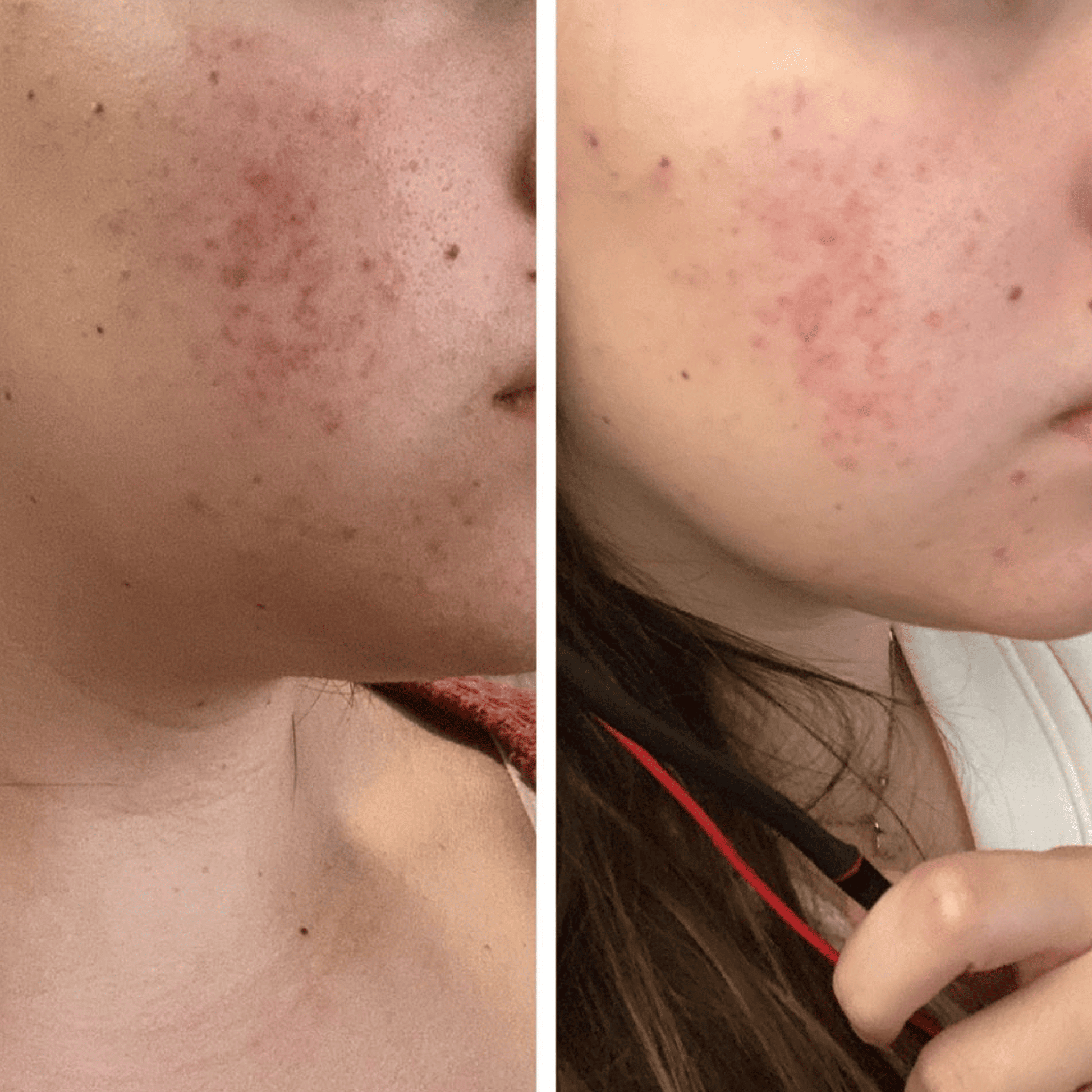 Before and after comparison of acne on a person's face.