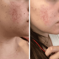 Before and after comparison of acne on a person's face.