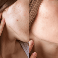 Before and after comparison of skin texture on a person's neck.