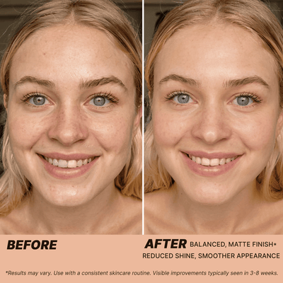 Before and after comparison of a person's face with text indicating skincare results.