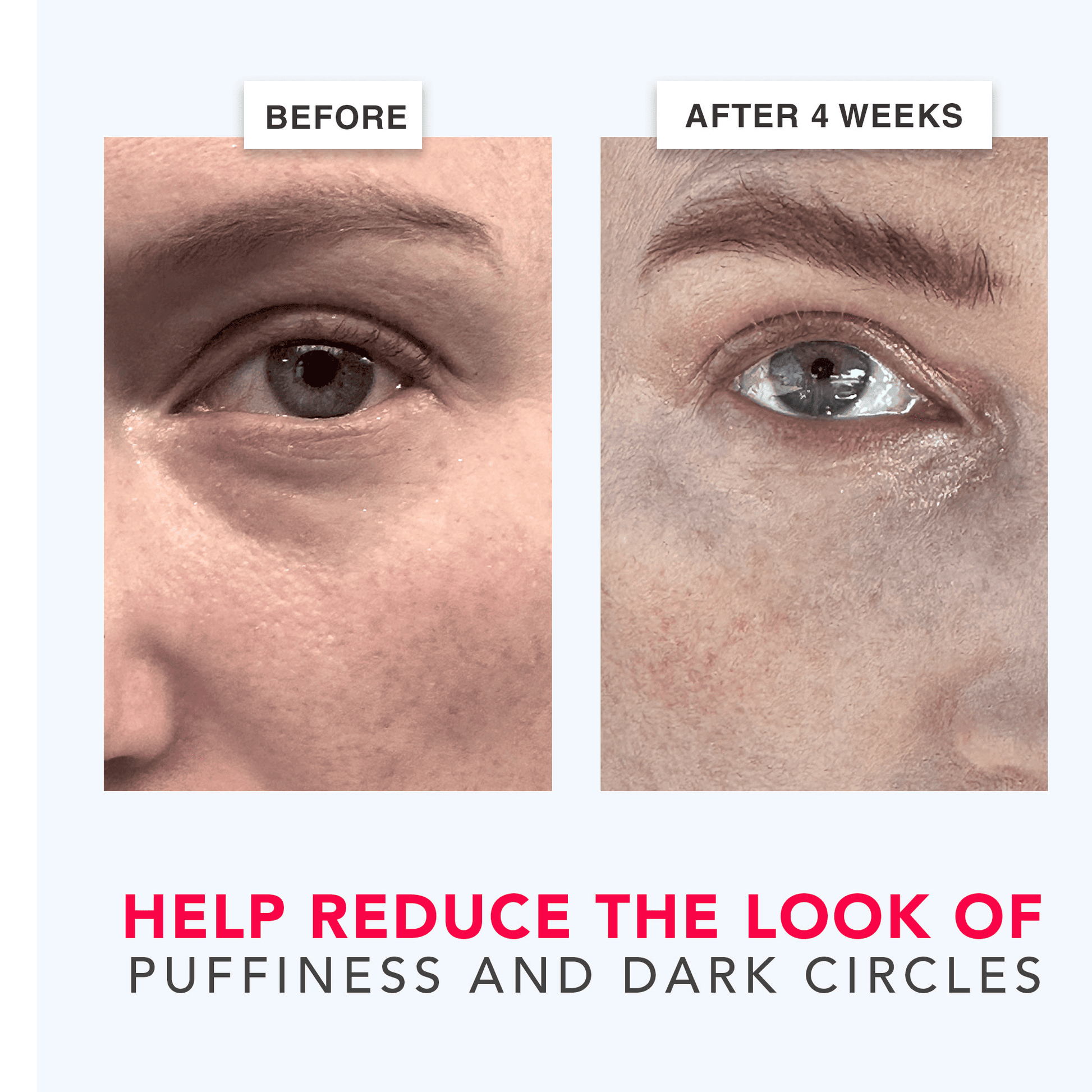Before and after comparison of eye area treatment showing reduced puffiness and dark circles.