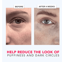 Before and after comparison of eye area treatment showing reduced puffiness and dark circles.