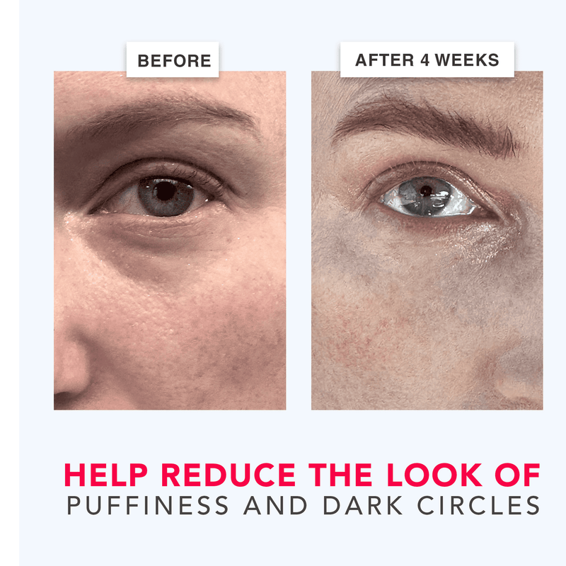 Before and after comparison of eye area treatment showing reduced puffiness and dark circles.