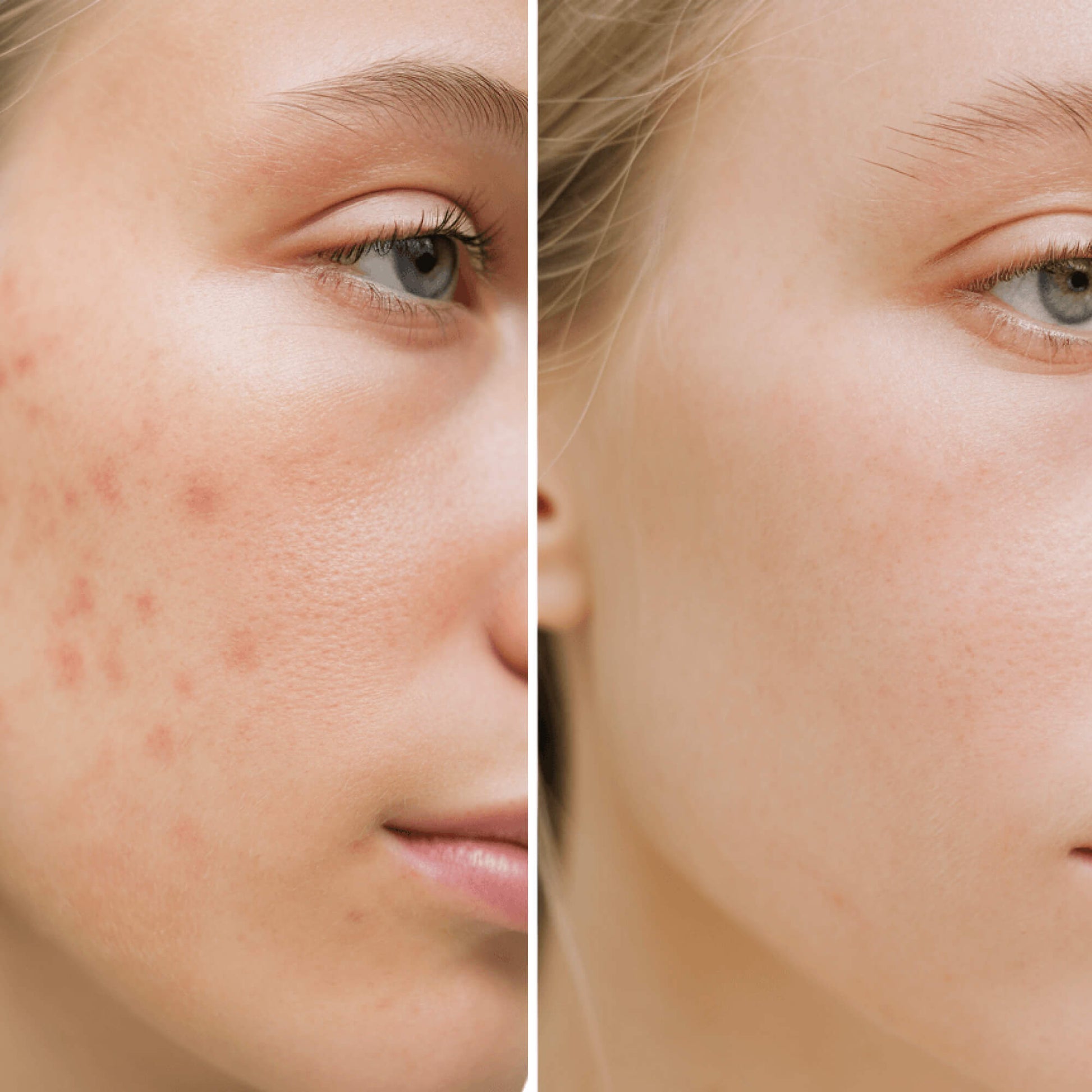 Before and after comparison of a person's face with acne on one side and clear skin on the other.