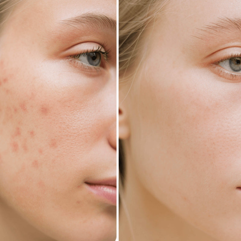 Before and after comparison of a person's face with acne on one side and clear skin on the other.