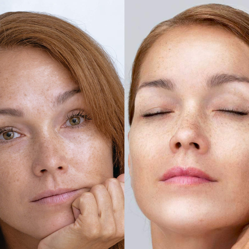 Before and after comparison of a woman's face with visible skin texture and freckles on the left, and smoother skin on the right.