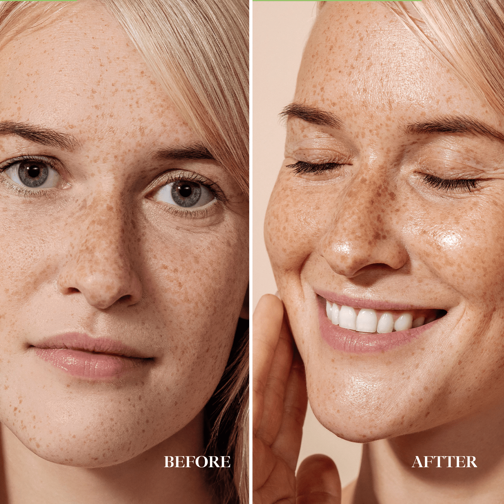 before after hyaluronic acid cream