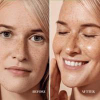 before after hyaluronic acid cream