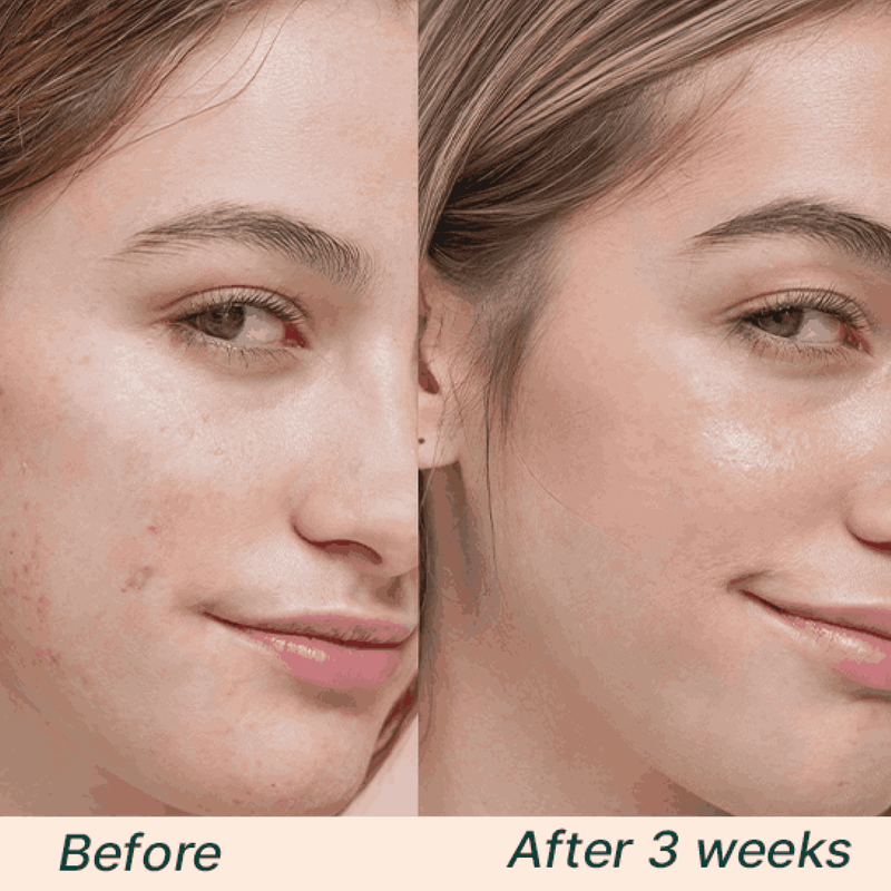 Before and after comparison of a woman's face with visible skin improvement over 3 weeks.