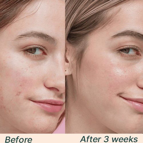 Hyaluronic Acid Quad Bundle