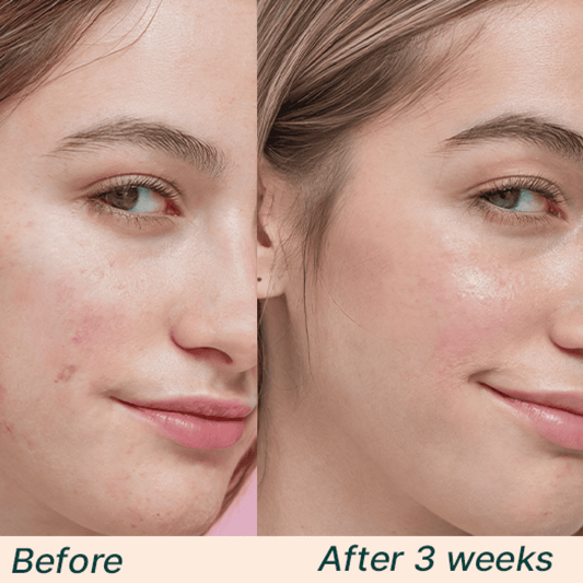 Before and after comparison of a woman's face with acne treatment showing clear skin after 3 weeks.