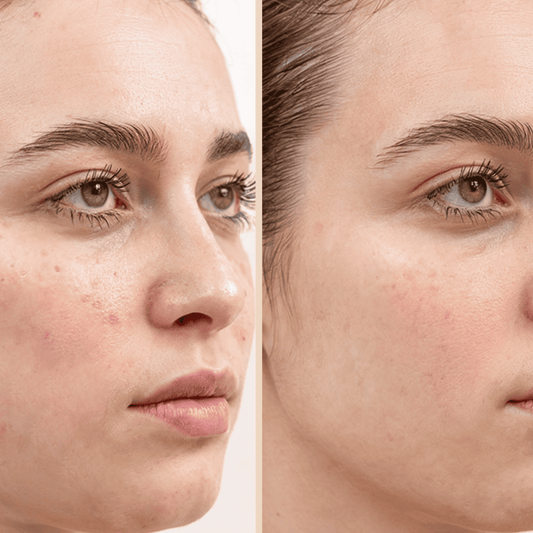 Before and after comparison of a woman's face with and without visible acne.