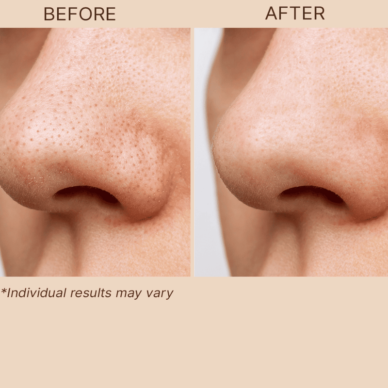 Before and after comparison of a nose with skin treatment, showing reduced pores.