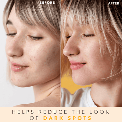 Before and after comparison of a person's face with text indicating dark spot reduction.